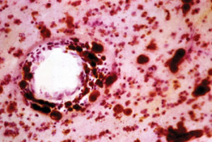 Metachromatic Leukodystrophy (MLD) brain stain