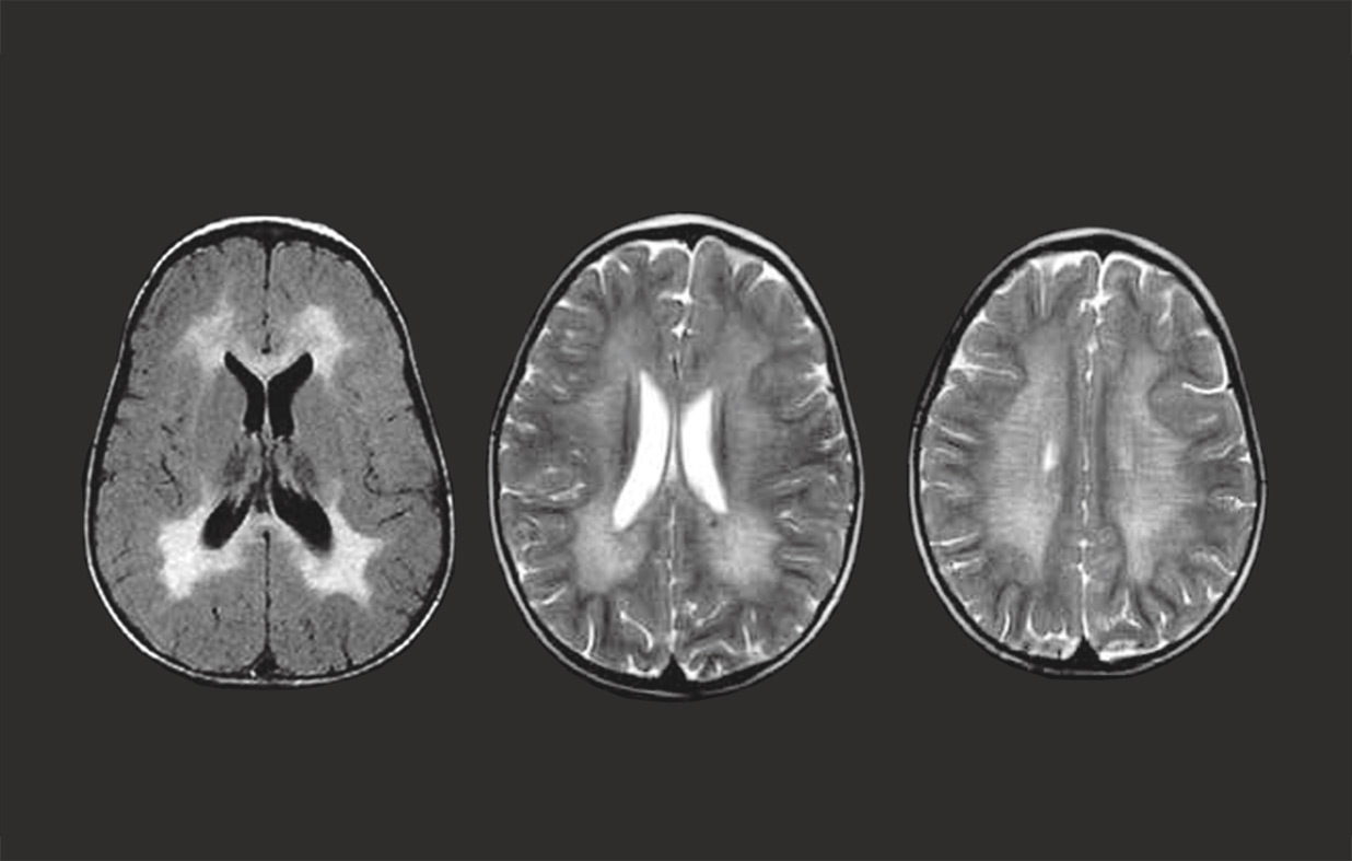 metachromatic leukodystrophy