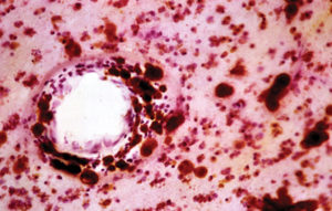 Metachromatic Leukodystrophy (MLD) brain stai