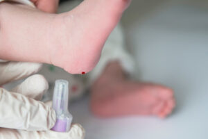 Neo Natal Screening MLD Metachromatic Leukodystrophy